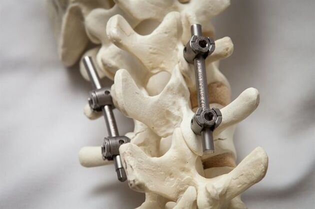 fixation of the spine osteochondrosis of the neck