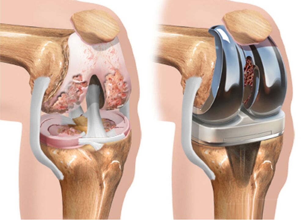 before and after osteoarthritis of the knee joint for osteoarthritis