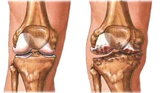 healthy knee and knee osteoarthritis