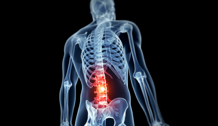 defeat of the lumbar spine in osteochondrosis