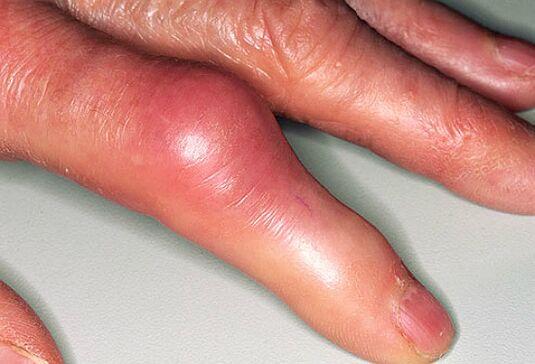 Gout is accompanied by sharp pain in the fingers and swelling of the joints. 