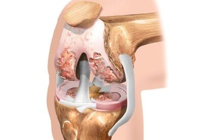 Damage to knee arthrosis joint
