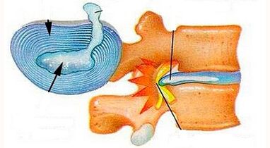 Characteristics of the development of cervical osteochondrosis