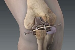 knee joint replacement for arthrosis