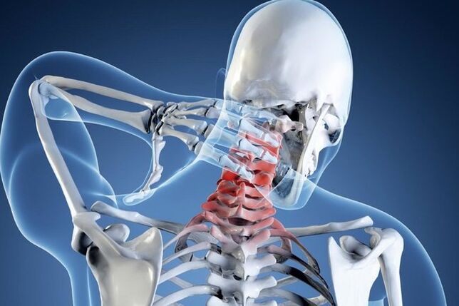 osteochondrosis of the cervical vertebrae